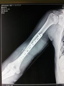 肱骨骨折恢复锻炼视频,视频教程详解