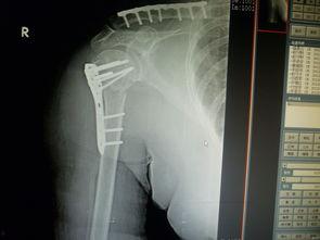 肱骨骨折恢复锻炼视频,视频教程详解