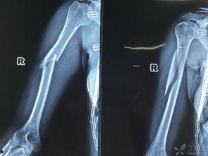 肱骨骨折恢复锻炼视频,视频教程详解